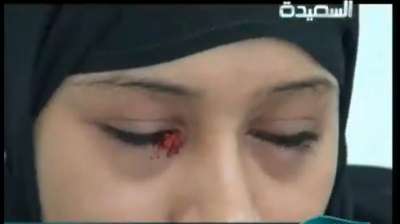 فتاة يمنية تتعرق دماً وتبكي حجراً ! .. فيديو