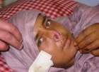 هندي يقطع أنف زوجته السابقة لزواجها من آخر