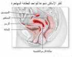مرض البطـانة المهاجرة أو بالانجليزية Endometriosis