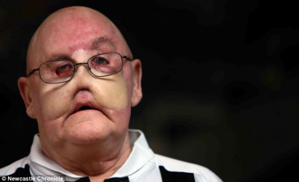 بالصور .. بقعة عادية في وجه رجل تتحول لسرطان نادر جدا 2 بالصور .. بقعة عادية في وجه رجل تتحول لسرطان نادر جدا