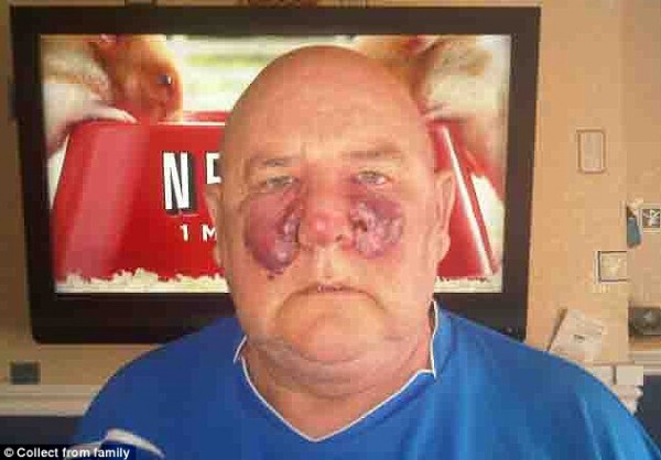 بالصور .. بقعة عادية في وجه رجل تتحول لسرطان نادر جدا 3 بالصور .. بقعة عادية في وجه رجل تتحول لسرطان نادر جدا