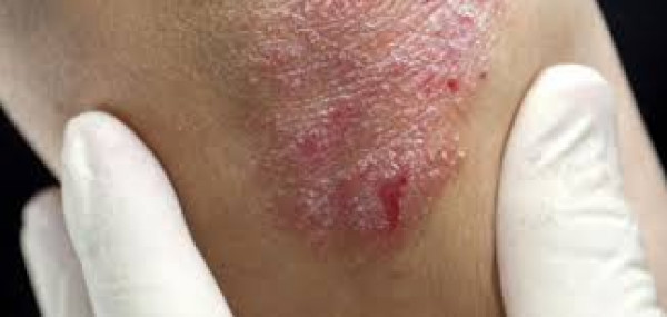 الأمراض الجلدية الأكثر شيوعا خلال فصل الشتاء 3911118100