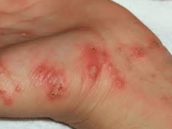الأمراض الجلدية الأكثر شيوعا خلال فصل الشتاء 3911118102