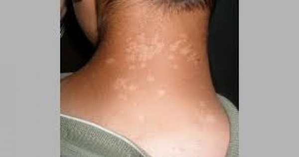الأمراض الجلدية الأكثر شيوعا خلال فصل الشتاء 3911118108