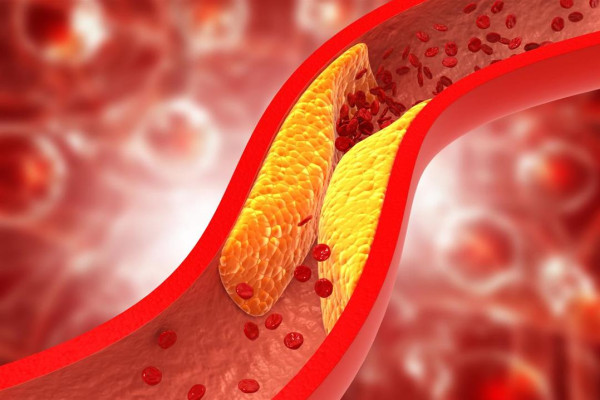 علامات تدل على ارتفاع نسبة الكوليسترول في جسدك