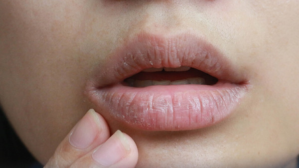 احذر.. جفاف الفم قد يكون عارضاً لخمسة أمراض خطيرة