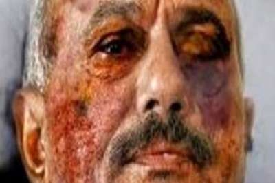 تداول صور "مزعومة" للرئيس اليمني والحروق تملأ وجهه