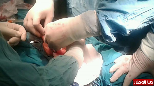 غزة : أطباء يعيدون الدفء للحياة الزوجية بمستشفى الأقصى .. صور