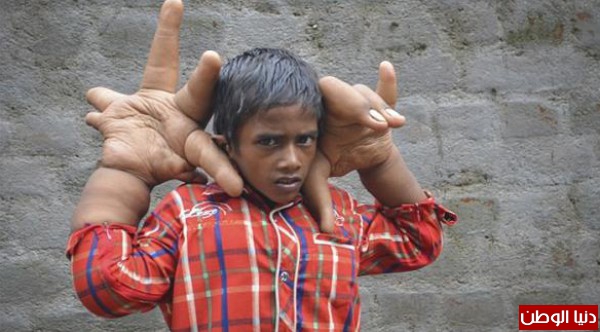 بالصور: طفل هندي يبلغ وزن يديه 16 كيلوغراماً
