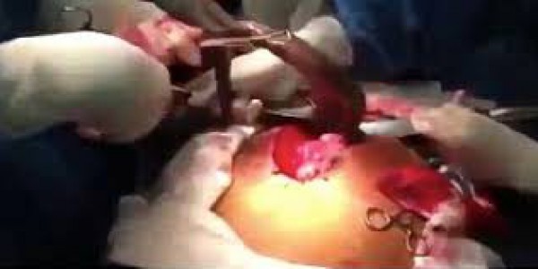 العثور على سمكة حية في بطن برازيلي