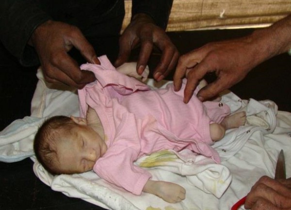 رضيع يقضي إثر نقص التغذية والرعاية الطبية بسبب الحصار المشدد على اليرموك