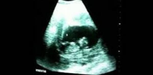 لقطات ترصد جنينًا يلعب في رحم أمه