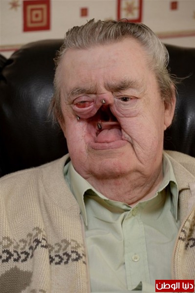 بالفيديو والصور: "عجوز" يفقد أنفه وعظام الخد بسبب "سرطان الجلد"