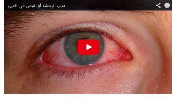هل تعلم ما سبب الرعشه أو النبض فى العين