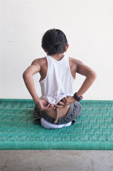 بالصور: طفل يفقد قدسيته بعد إزالة ذيل في ظهره بالهند
