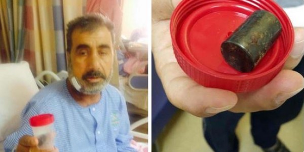 جسم معدني تم استخراجه من فكّ حاج سوري أُصيب في حادثة رافعة الحرم المكي