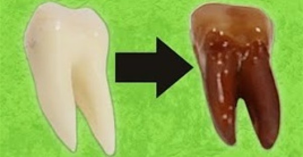 بالفيديو.. شاهد ماذا يحدث للأسنان عند وضعها 5 أيام في مشروب غازى