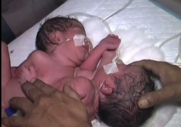 بالفيديو .. ولادة نادرة لتوأمين ملتصقين وبصحة جيدة بالهند