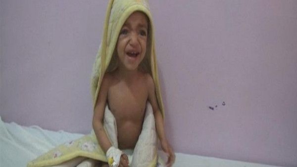 أكثر من مليون طفل يمني يدفعون ثمن الانقلاب