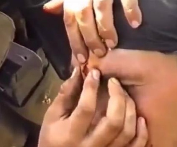 إخراج رصاصة من رأس جندي روسي حي