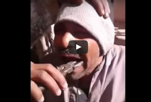 شاهد: مصري يخلع ضرسه بـ"الكماشة"