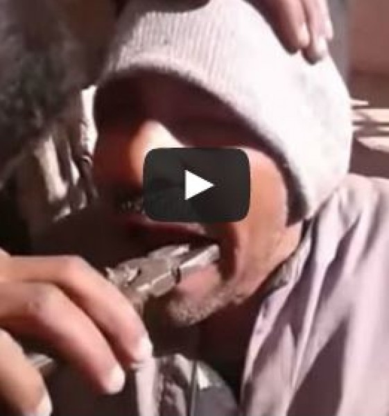 رجل يخلع ضرسه بـ"كماشة"