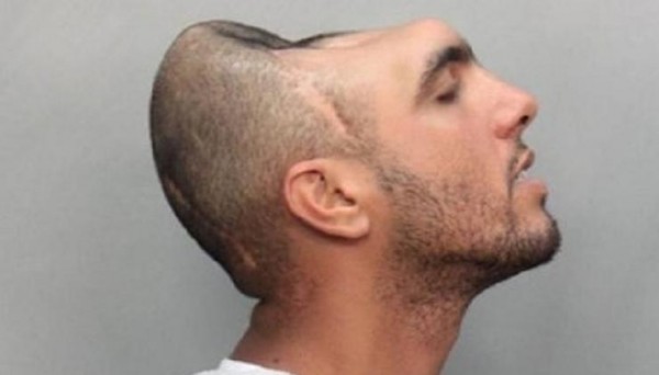 صورة حقيقية.. شاب يعيش بنصف رأس فقط!