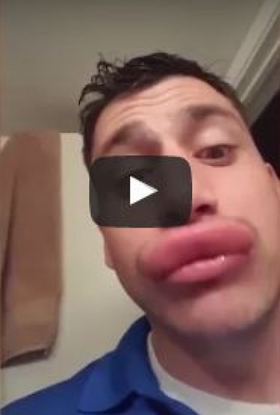 شاهد ماذا فعلت الدبابير بشفتي هذا الرجل