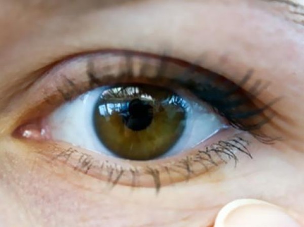 زرع خلايا جديدة للعين.. اكتشاف يعيد النظر لفاقديه