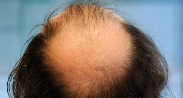 دراسة: أدوية منع تساقط الشعر تؤثر على القدرة الجنسية للرجل