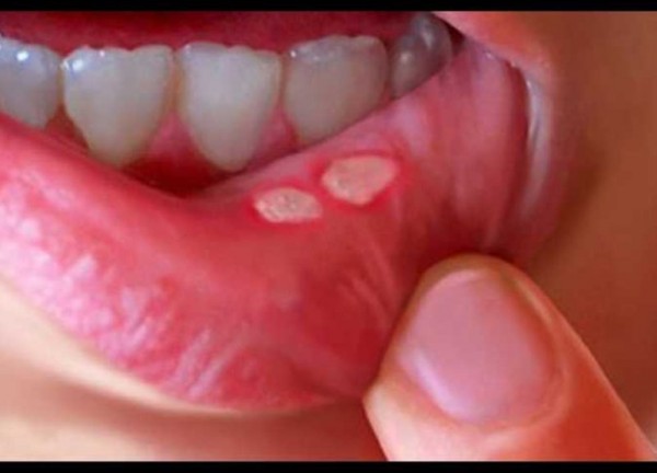 طريقة سحرية لعلاج قرح الفم خلال ساعات فقط