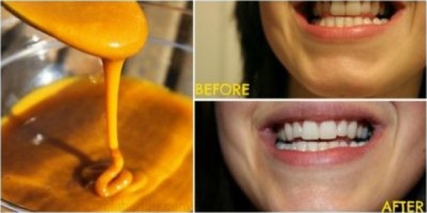 إليك حيلة يستخدمها أطباء الأسنان سرًا لتبييض أسنانهم