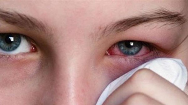 هذه آثار لقاح النخل وغبار الربيع على العين