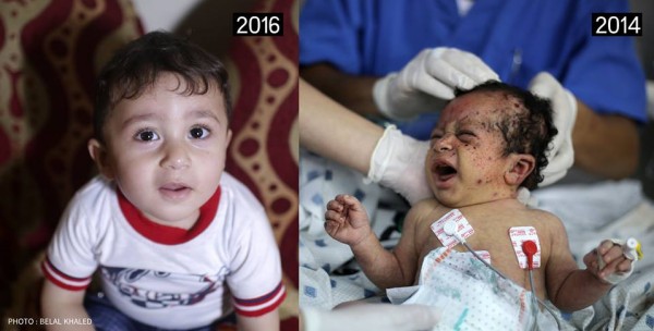 لازالت الصدمة تكسو ملامحهم.. كيف يبدو مُصابي حرب غزة 2014 بعد سنوات من النجاة؟