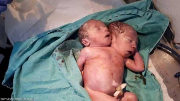شاهد: ليست الأولى.. ولادة طفل برأسين في إدلب السورية