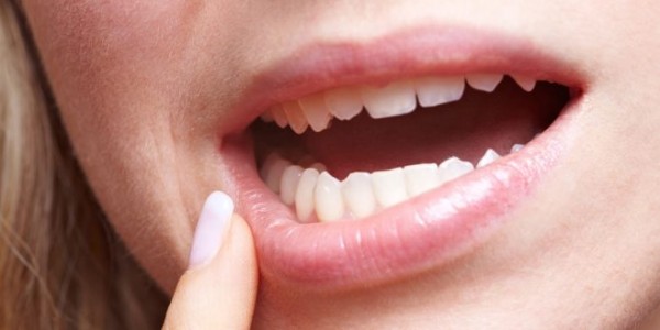 3 حيل سهلة للتخلص من تقرحات الفم المؤلمة