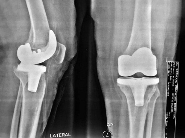 كلية طب المستنصرية تجري عملية تبديل مفصل الركبة الأيسر لمريضة في مستشفى اليرموك
