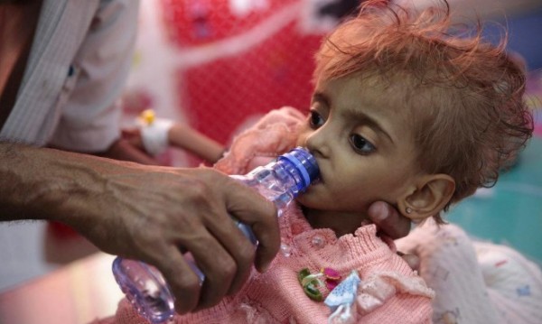 أكثرُ من مليونيّ طفل يمني يُعانون سوءَ التغذية الحاد