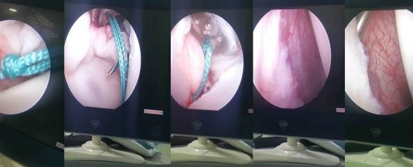 نجاح عملية جراحية نوعية في عدن لإصلاح خُلع متكرر لمفصل الكتف بالمنظار