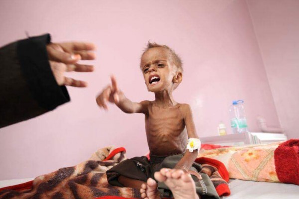 تقديرات بمصرع نحو 85 ألف طفل يمني جوعاً منذ عام 2015