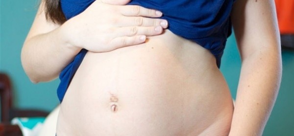لهذا السبب عملية شفط الدهون مناسبة للمرأة بعد الولادة القيصرية