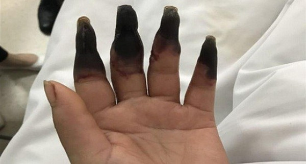 ماذا فعلت هذه المرأة كي تتحوّل أصابعها إلى اللون الأسود؟