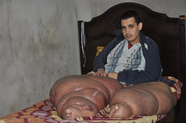 غزة: "صلاح الدين" يُعاني منذ طفولته بسبب "داء الفيل".. والطبيب المُعالج يصدمه بتكلفة العلاج