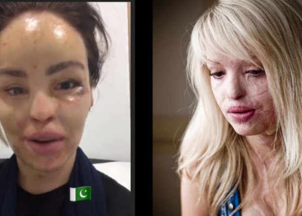 صور: بعد 200 عملية تجميل.. الحسناء كاتي بايبر تعود للحياة
