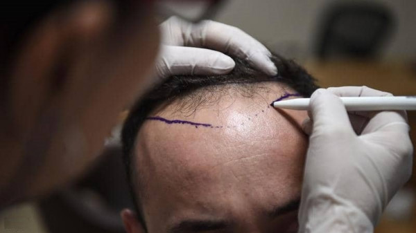 قد تنتهي بالسكتات والنوبات.. وفاة شخص في عملية زراعة شعر تحير الأطباء