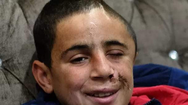 الاحتلال يُوجه تهماً للطفل الجريح محمد التميمي وعائلته تُطالب بتدخل دولي