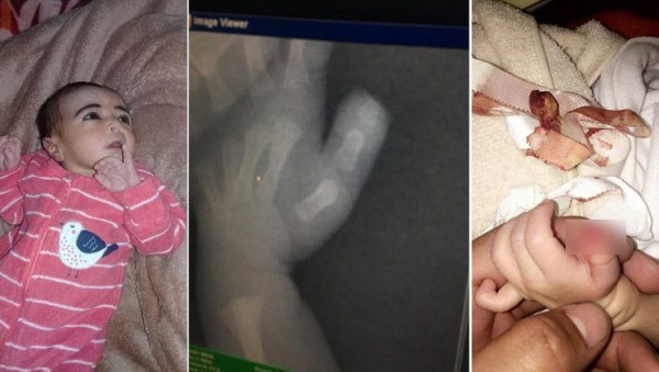 حادثة غريبة بالسعودية: بتر غامض في إصبع مولودة.. والممرضة: كانت ترضع وقطعته