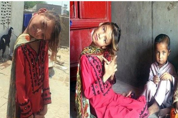 فتاة باكستانية تعيش برقبة غريبة