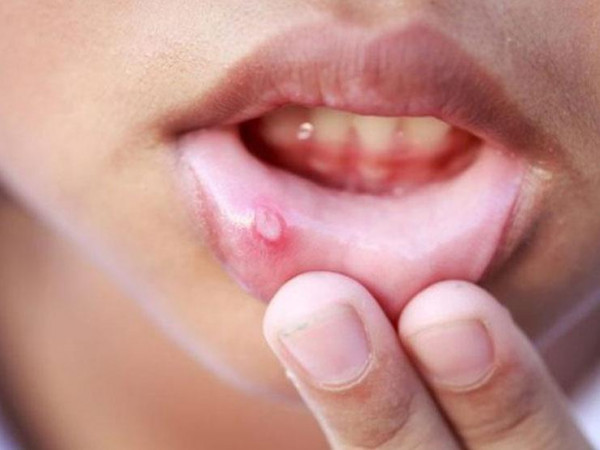 كيفية تجنب الإصابة بقرحة الفم