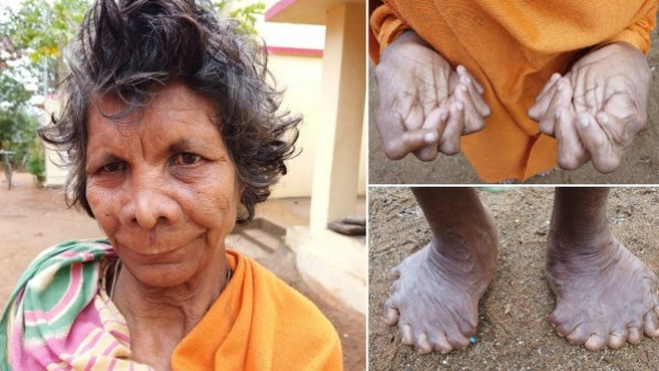 "الساحرة الشريرة".. سيدة تمتلك 31 أصبعاً تلتزم منزلها منذ 63 عامًا
